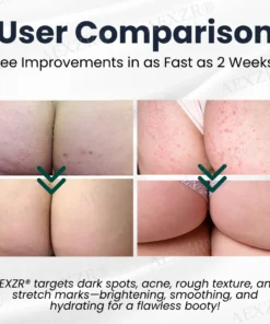 AEXZR® Butt Skin Treatment Cream