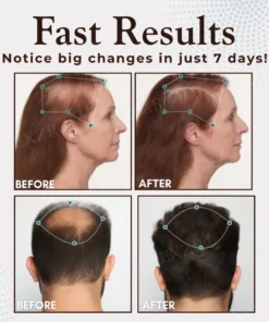 AEXZR® Hair Regrowth Capsules