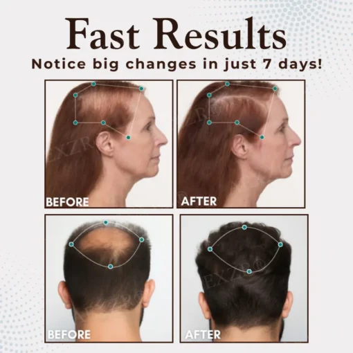 AEXZR® Hair Regrowth Capsules