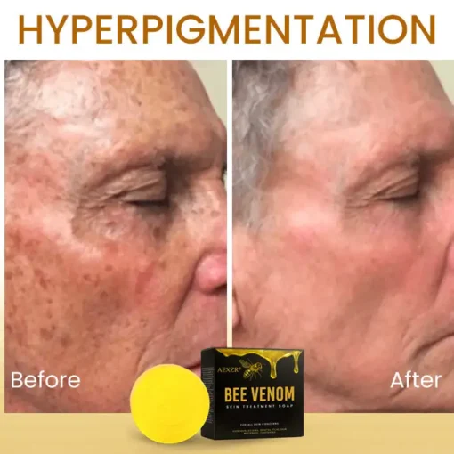 AEXZR® Bee Venom Skin Treatment Soap