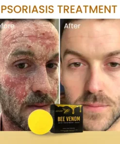 AEXZR® Bee Venom Skin Treatment Soap