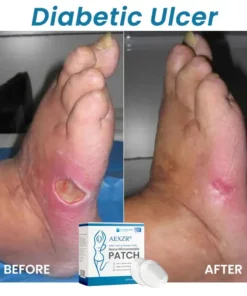 AEXZR® SMGT-GLP1 & Matrixyl 3000 Nano Microneedle Patch
