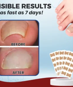 AEXZR™ Paronychia Correcting Patch