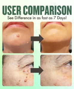 AEXZR® WartsOff Instant Blemish Removal Cream