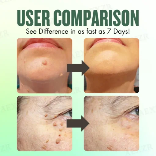 AEXZR® WartsOff Instant Blemish Removal Cream