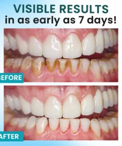 AEXZR® Oral Calculus Suppressant