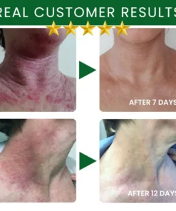 AEXZR® Tea Tree Oil Skin Treatment Cream