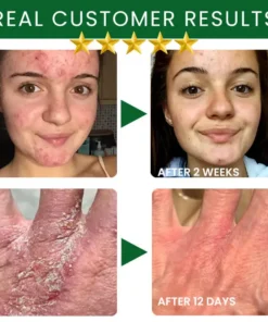 AEXZR® Tea Tree Oil Skin Treatment Cream