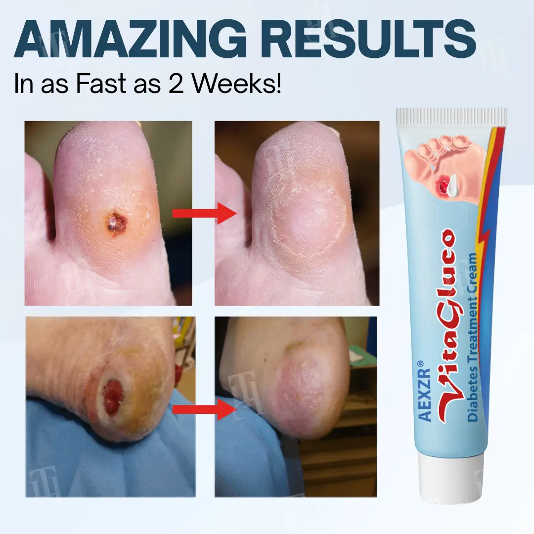AEXZR® VitaGluco Diabetes Treatment Cream