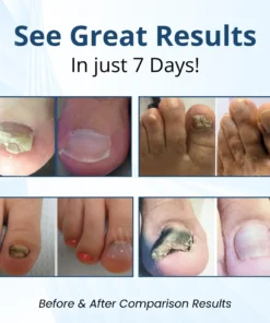 AEXZR® MycoShield Pro Fungal Nail Patches