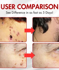 AEXZR® Nano-Microdart Skin Tag & Spot Corrector Patches