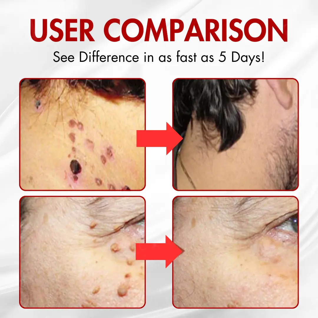 AEXZR® Nano-Microdart Skin Tag & Spot Corrector Patches