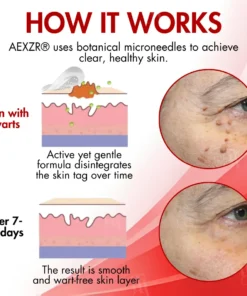 AEXZR® Nano-Microdart Skin Tag & Spot Corrector Patches