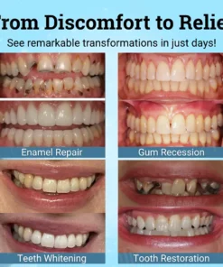 AEXZR® Non-Surgical Gum "Suture" Gel