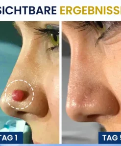 AEXZR® Hautanhängsel-Kryo-Behandlungsspray