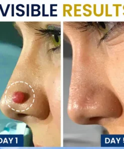 AEXZR® Skin Tag Cryo Treatment Spray Precision Cryo-Tech Freezes Away Skin Tags Warts in Seconds No Blades, No Pain.