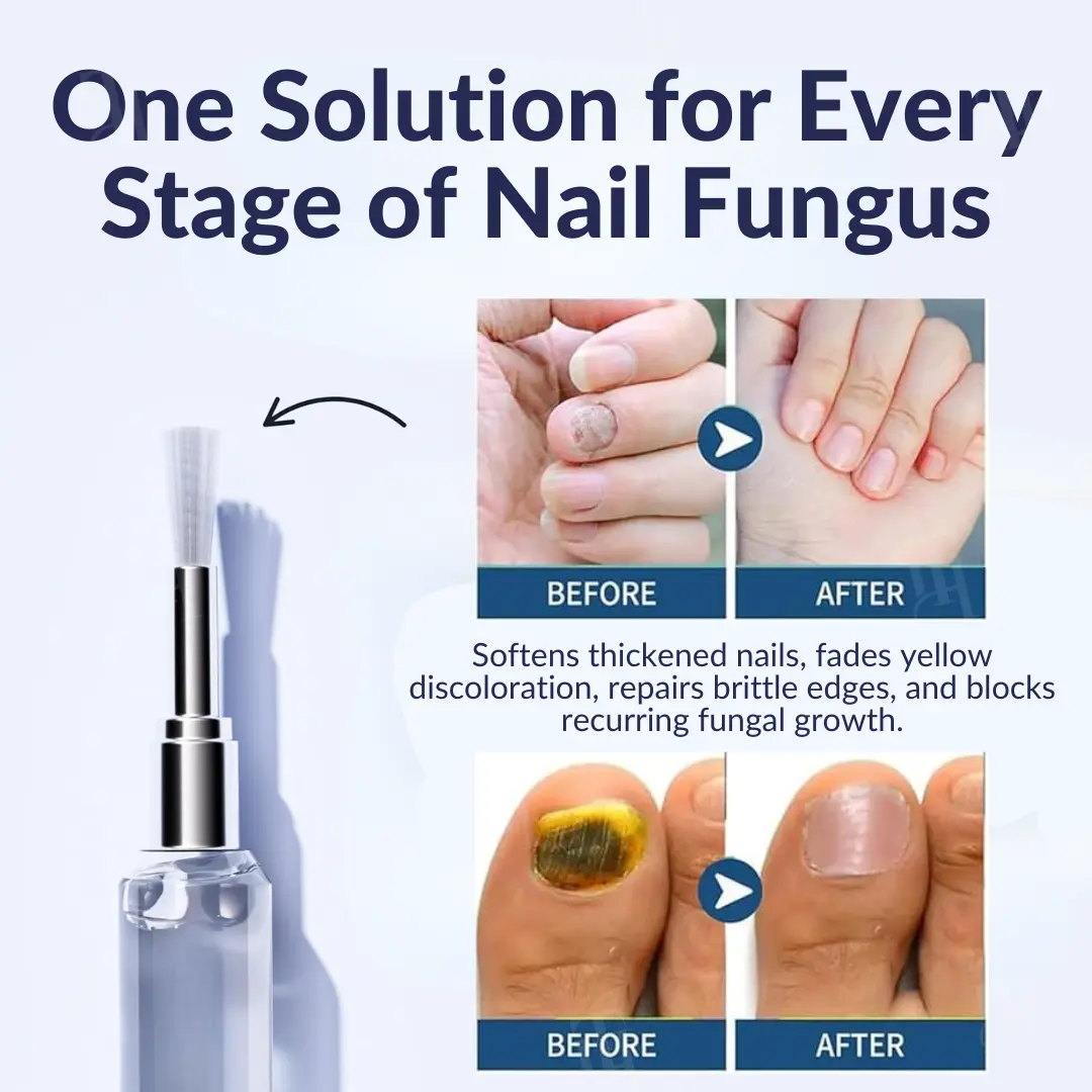 AEXZRยฎ Next-Gen Antifungal Max-Pen (๐๐ข๐ฌ๐ข๐๐ฅ๐ ๐ซ๐๐ฌ๐ฎ๐ฅ๐ญ๐ฌ ๐ข๐ง ๐ ๐๐๐ฒ๐ฌ) ๐
๐จ๐ซ ๐๐๐ข๐ฅ ๐
๐ฎ๐ง๐ ๐ฎ๐ฌ, ๐๐ข๐ฌ๐๐จ๐ฅ๐จ๐ซ๐๐ ๐๐๐ข๐ฅ๐ฌ, ๐๐ซ๐ข๐ญ๐ญ๐ฅ๐ ๐๐๐ข๐ฅ๐ฌ, ๐๐ง๐ ๐ฆ๐จ๐ซ๐