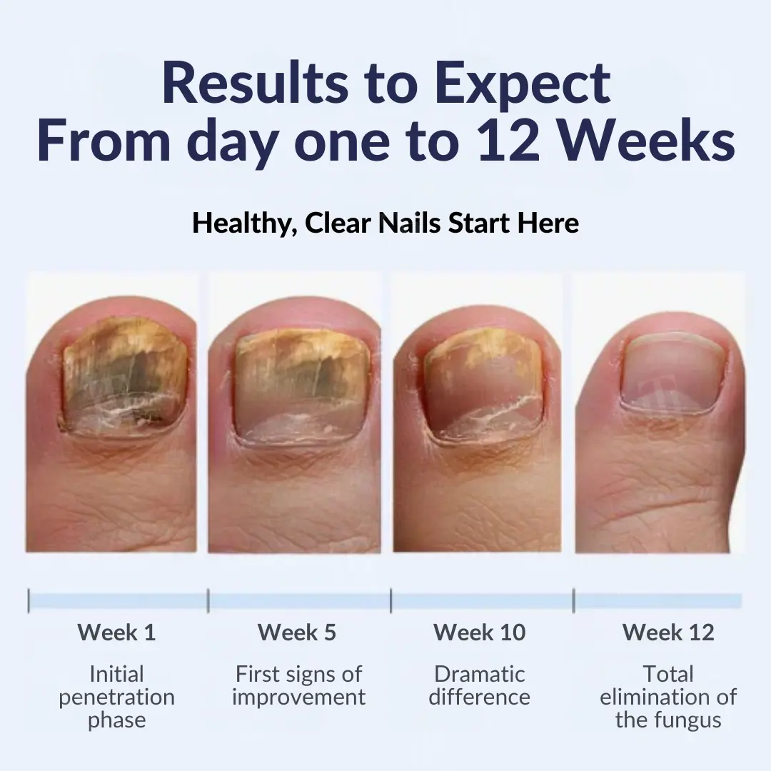 AEXZRยฎ Next-Gen Antifungal Max-Pen (๐๐ข๐ฌ๐ข๐๐ฅ๐ ๐ซ๐๐ฌ๐ฎ๐ฅ๐ญ๐ฌ ๐ข๐ง ๐ ๐๐๐ฒ๐ฌ) ๐
๐จ๐ซ ๐๐๐ข๐ฅ ๐
๐ฎ๐ง๐ ๐ฎ๐ฌ, ๐๐ข๐ฌ๐๐จ๐ฅ๐จ๐ซ๐๐ ๐๐๐ข๐ฅ๐ฌ, ๐๐ซ๐ข๐ญ๐ญ๐ฅ๐ ๐๐๐ข๐ฅ๐ฌ, ๐๐ง๐ ๐ฆ๐จ๐ซ๐