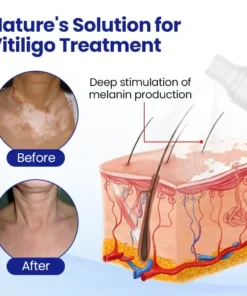 AEXZR® Vitiligo Treatment Spray