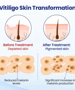 AEXZR® Vitiligo Treatment Spray