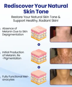 AEXZR® Vitiligo Treatment Spray