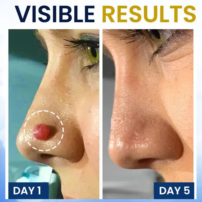 AEXZR® cryotherapy Spray: Quick removal of warts and corneas - results visible in 7 days