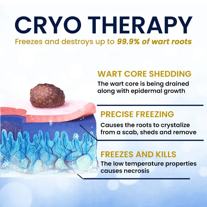 AEXZR® cryotherapy Spray: Quick removal of warts and corneas - results visible in 7 days