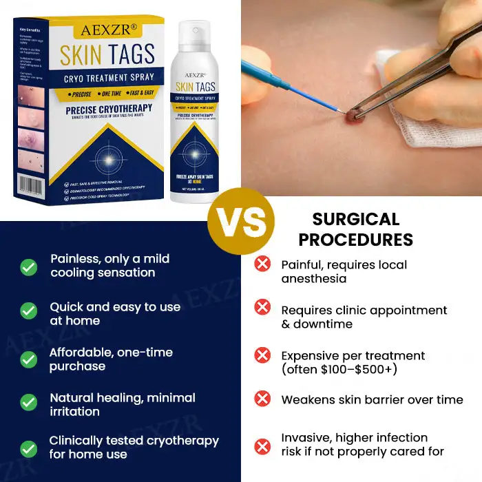 AEXZR® cryotherapy Spray: Quick removal of warts and corneas - results visible in 7 days