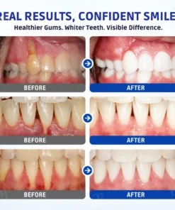 AEXZR® Gum Protect Repair Gel